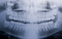 Diplomado Implantología Avanzada Sistema ISIS RG Implantes Dentales